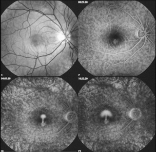 Vier Aufnahmen des Augenhintergrunds aus einer Angiographie in zeitlicher Folge, mit zunehmendem Farbstoffaustritt im Bereich der Makula