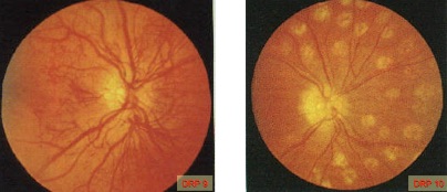 Bild 9 und 10 (DRP 9, DRP 10): Augenhintergrund mit Gefäßneubildungen vor (links) und nach der Laserkoagulation mit Lasernarben (rechts)