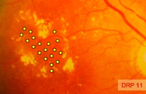 Bild 11 (DRP 11): Netzhautmitte mit Lipid-Ablagerungen; gelbe Punkte markieren die Stellen der gezielten Laserbehandlung