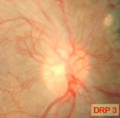 Bild 3 (DRP 3): Gefäßneubildungen (Neovaskularisationen) am Sehnervenkopf