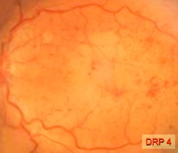 Bild 4 (DRP 4): Augenhintergrund mit Fleckblutungen in der Netzhaut