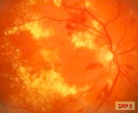 Bild 5 (DRP 5): Makula mit gelblichen Lipid-Exsudaten und Flüssigkeitsansammlungen
