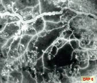 Bild 6 (DRP 6): Fluoreszein-Angiographie mit krankhaft veränderten Netzhautgefäßen und Lücken im Kapillarnetz