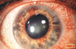 Bild 8 (DRP 8): vorderer Augenabschnitt mit Gefäßneubildungen an der Iris
