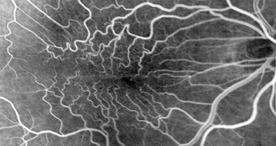 Schwarz-weiße Gefäßdarstellung (Angiographie) der Makula mit verzogenen, geschlängelten Netzhautgefäßen