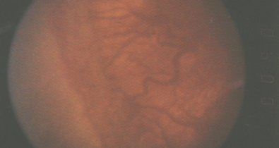 Aufnahme des Augenhintergrunds bei Retinopathia praematurorum