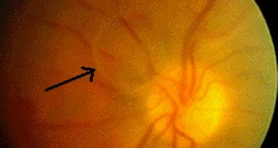 Aufnahme des Augenhintergrunds mit Sehnervenkopf; ein schwarzer Pfeil weist auf eine Trübung vor der Netzhaut